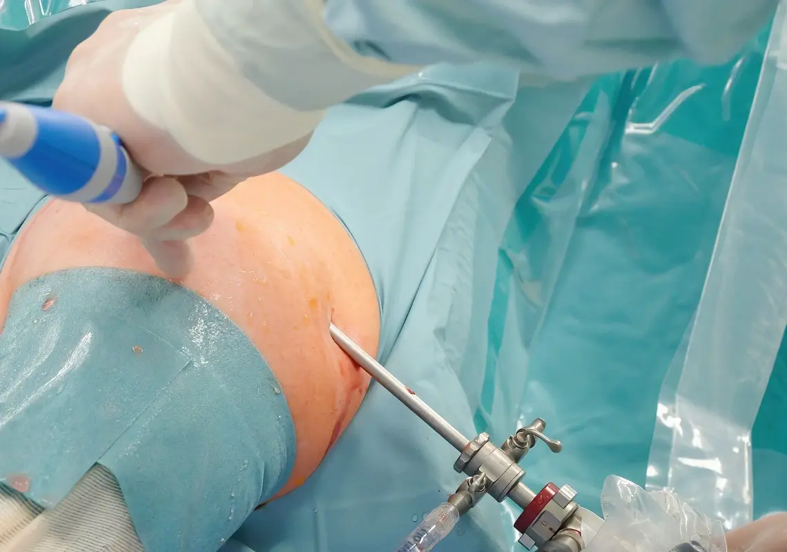 Artroskopia operacyjna barku bez implantów