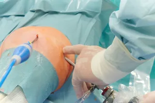 Obraz Plastyka niestabilności stawu barkowo-obojczykowego