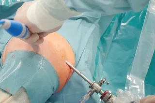 Artroskopia operacyjna barku bez implantów